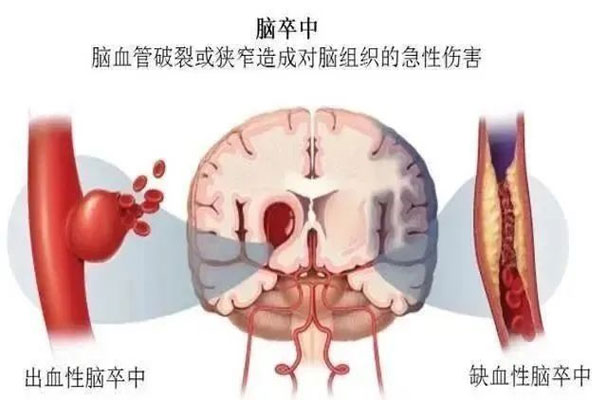 中风,缺血性中风,出血性中风 中风,缺血性中风,出血性中风