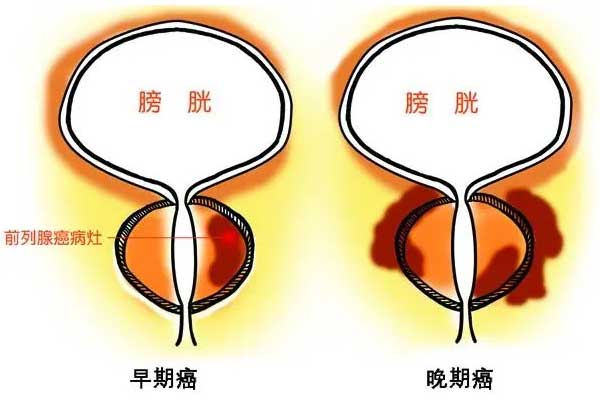 前列腺癌 前列腺癌